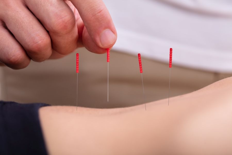 5 Reasons New Yorkers Should Try Acupuncture