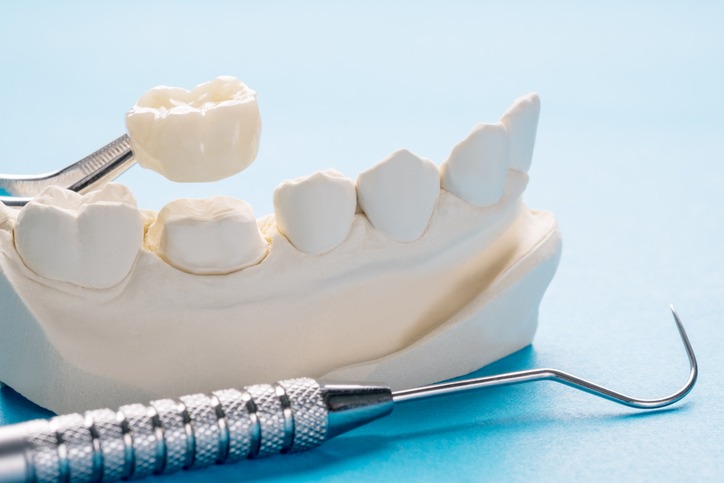 Graduating Towards Dental Crowns Wouldn’t Negatively Affect You – Learn the Advantages